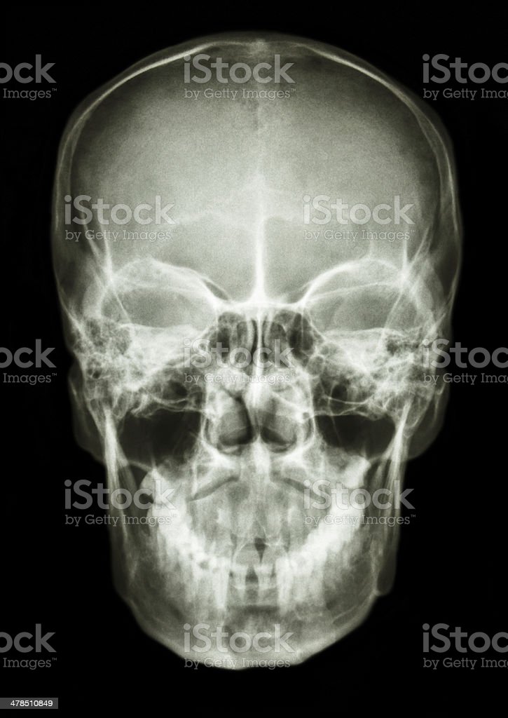 Detail Foto Skull Radiologi Nomer 21
