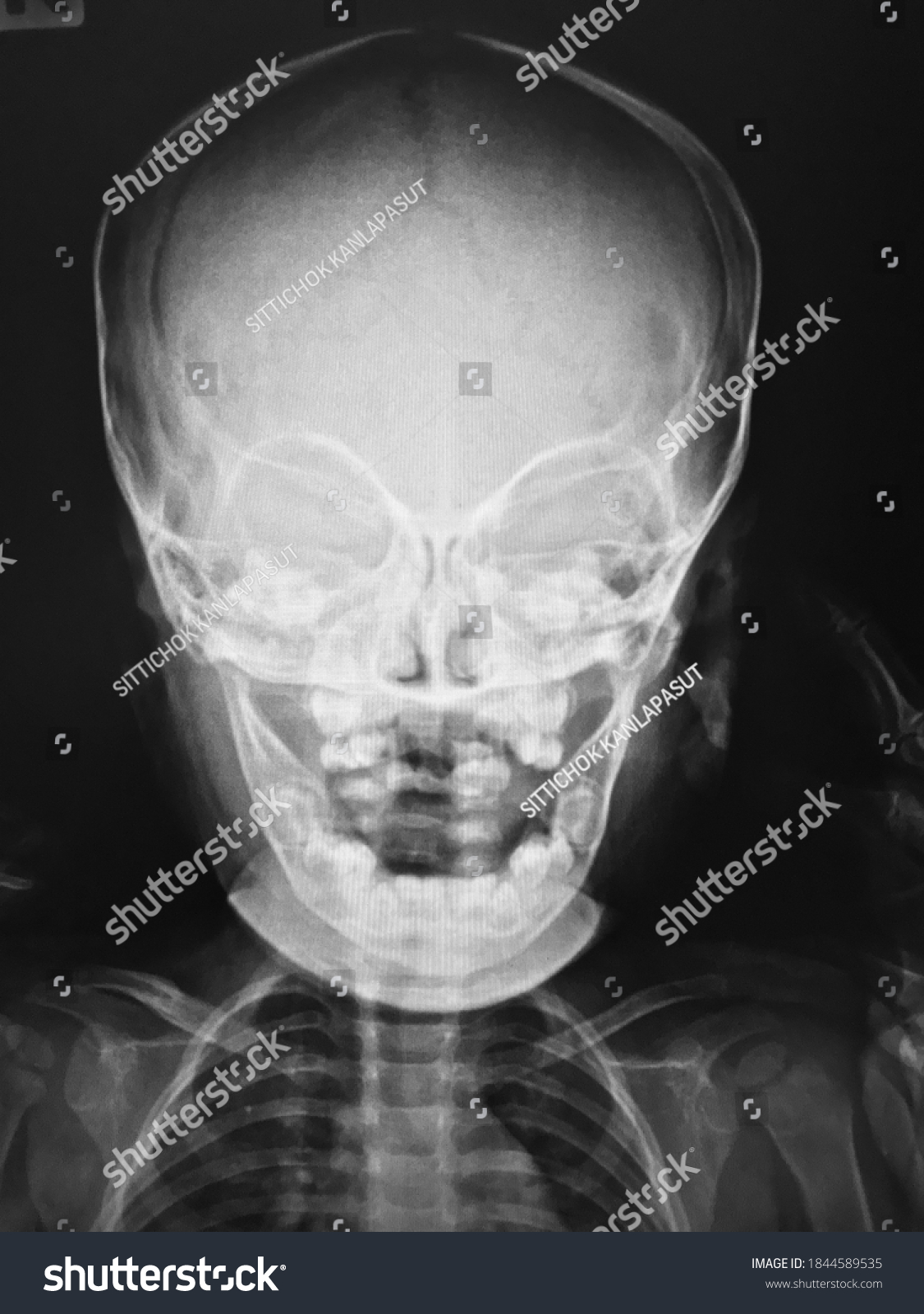 Detail Foto Skull Radiologi Nomer 25