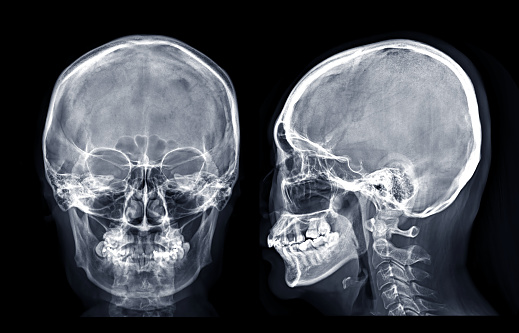 Detail Foto Skull Radiologi Nomer 26