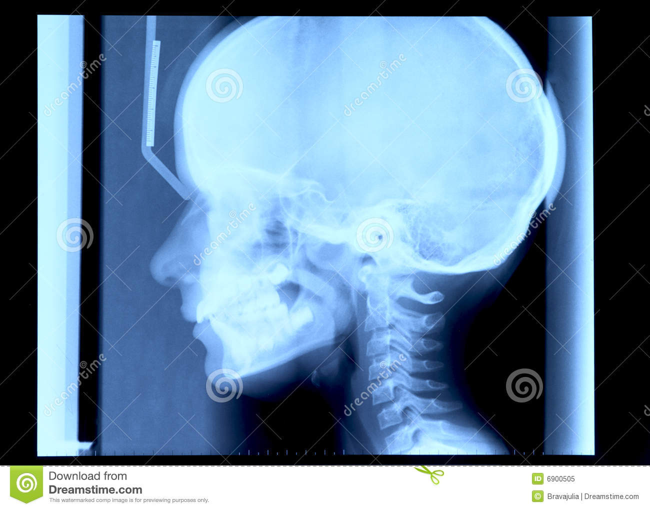 Detail Foto Skull Radiologi Nomer 28