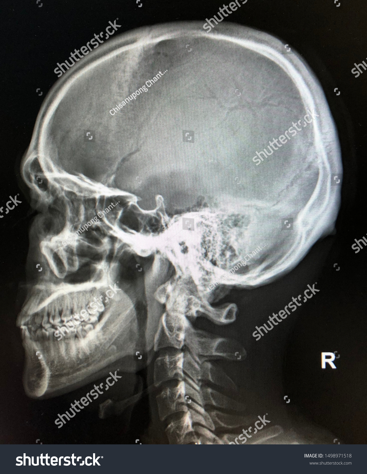 Detail Foto Skull Radiologi Nomer 30