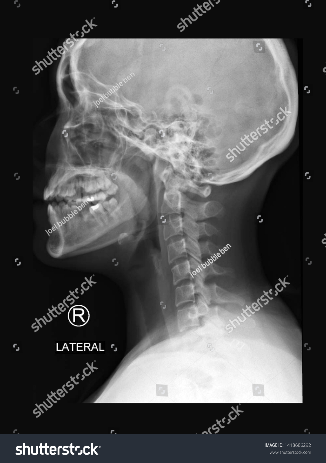 Detail Foto Skull Radiologi Nomer 51