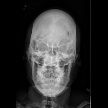 Detail Foto Skull Radiologi Nomer 10
