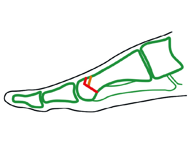 Detail Bluterguss Nach Hallux Valgus Op Koleksi Nomer 15