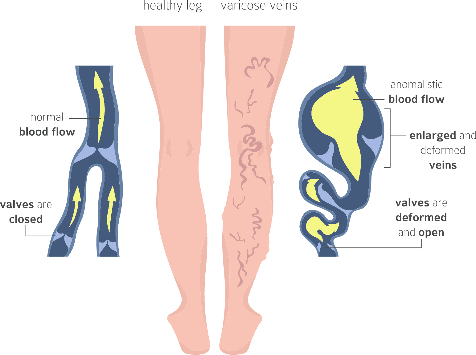 Detail Phlebitis Bilder Nomer 18