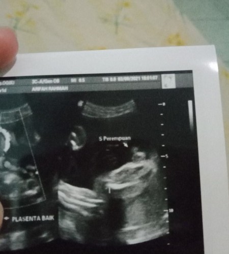 Detail Foto Usg Bayi Laki Laki Nomer 16