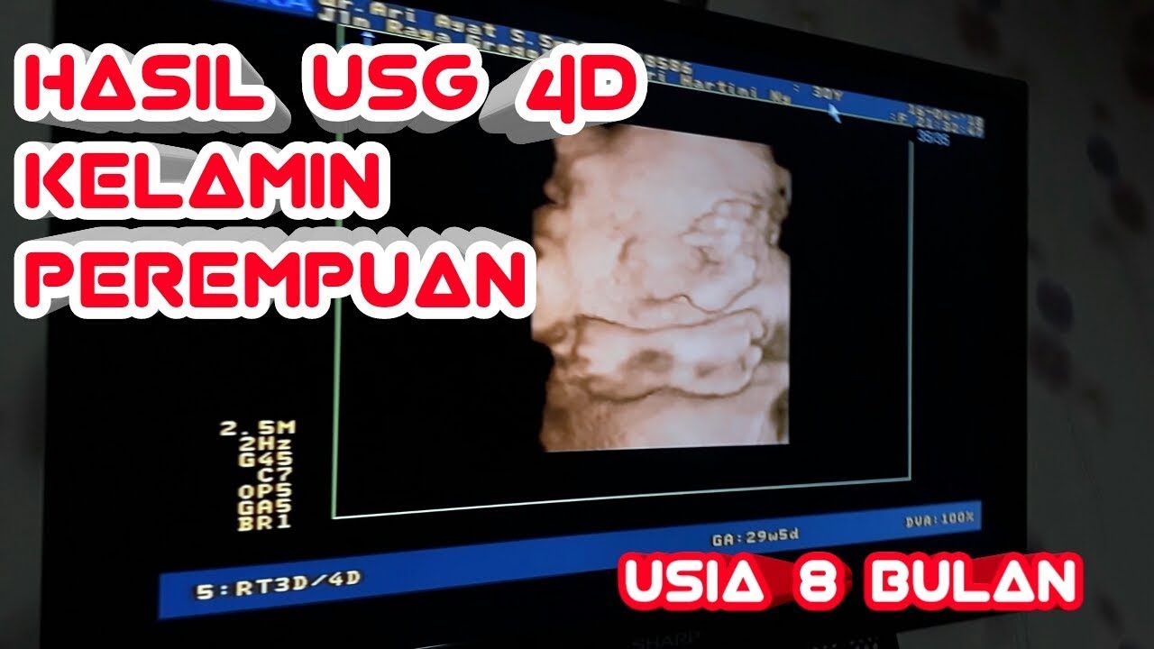 Detail Foto Usg Bayi Laki Laki Nomer 47