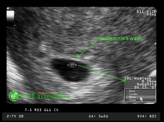 Detail Foto Usg Janin 5 Minggu Nomer 32