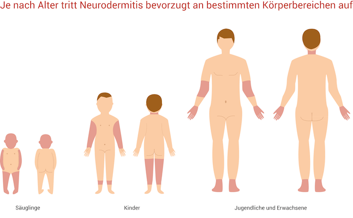 Detail Hauterkrankungen Kinder Nomer 3