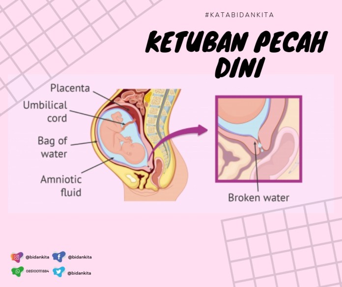 Detail Gambar Air Ketuban Pecah Nomer 15