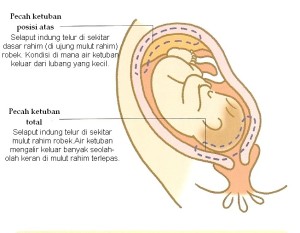 Detail Gambar Air Ketuban Pecah Nomer 4