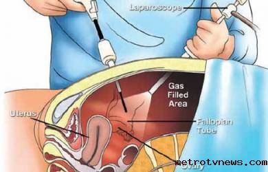 Detail Gambar Alat Transplantasi Ginjal Nomer 13