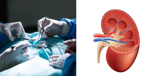 Detail Gambar Alat Transplantasi Ginjal Nomer 8