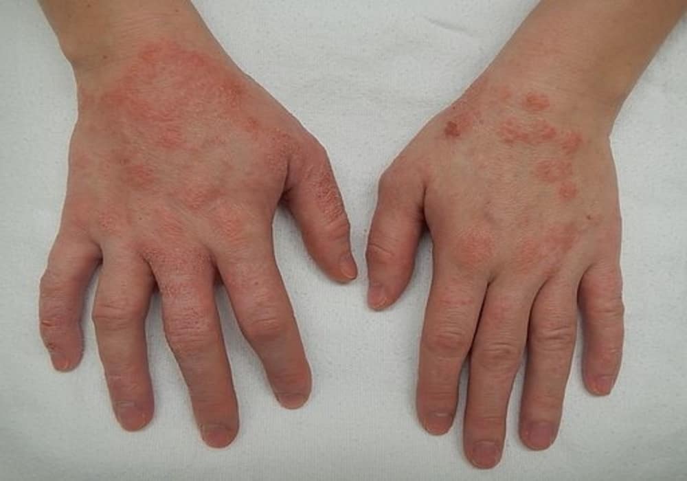 Detail Gambar Alergi Kulit Nomer 21
