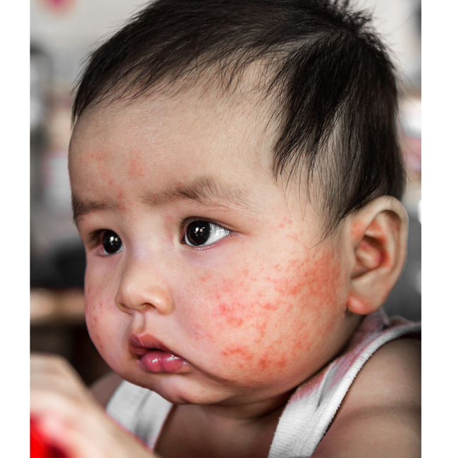 Detail Gambar Alergi Pada Anak Nomer 55