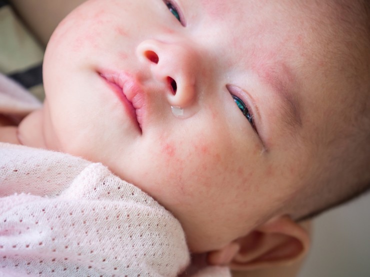 Detail Gambar Alergi Pada Bayi Nomer 17