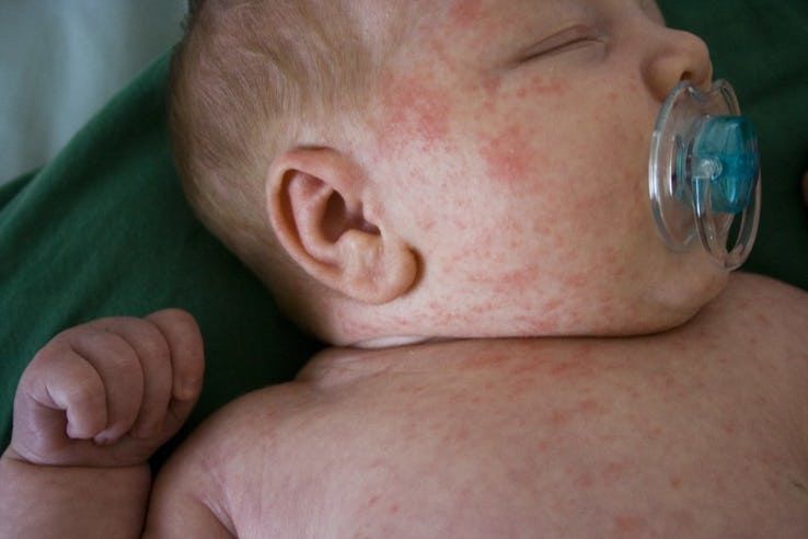 Detail Gambar Alergi Pada Bayi Nomer 34