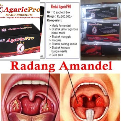 Detail Gambar Amandel Bengkak Nomer 48