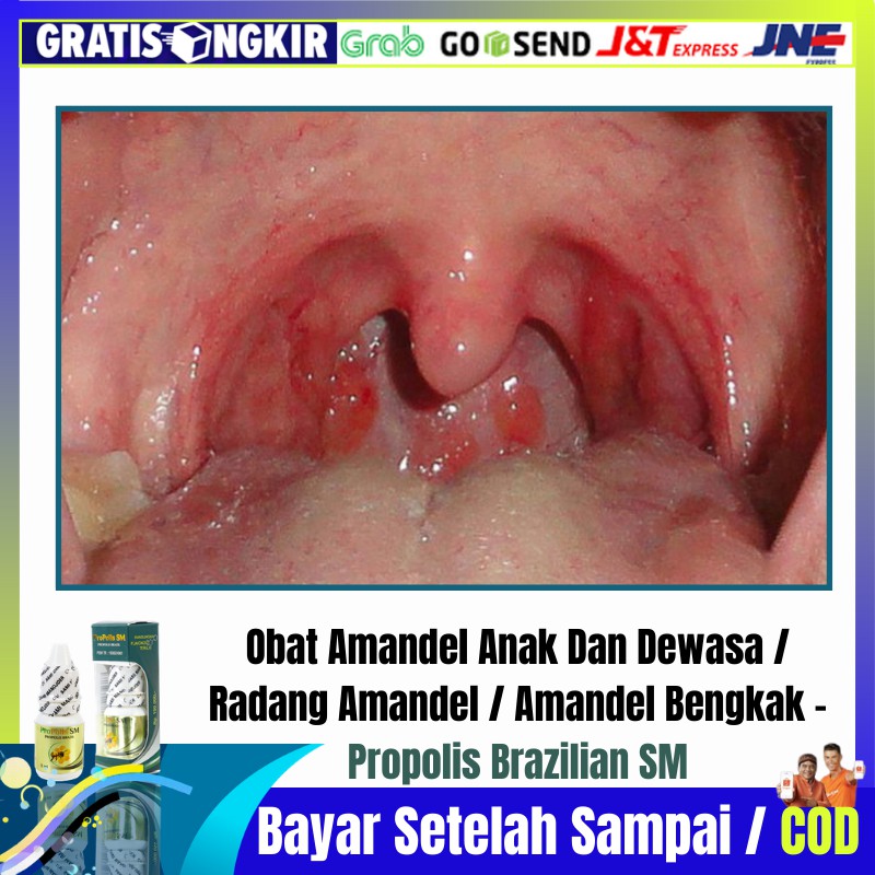 Detail Gambar Amandel Bengkak Nomer 10