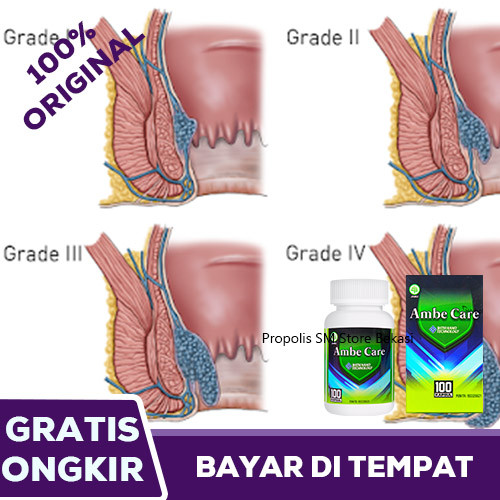 Detail Gambar Ambeien Stadium 2 Nomer 32