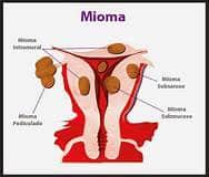 Detail Gambar Amenore Primer Gambar Penyakit Kriptorkidisme Nomer 5