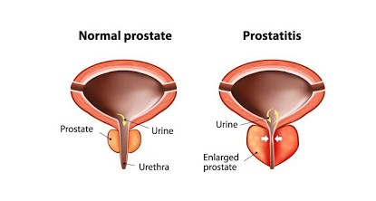 Detail Gambar Amenore Primer Gambar Penyakit Kriptorkidisme Nomer 37