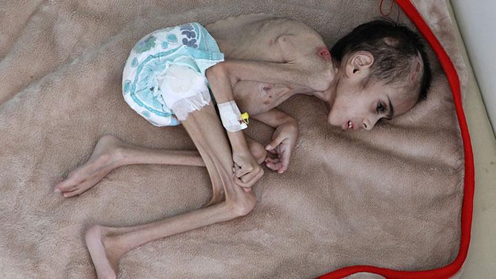 Detail Gambar Anak Kelaparan Nomer 10