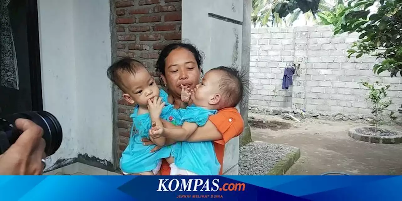 Detail Gambar Anak Kembar Siam Di Dunia Nomer 25