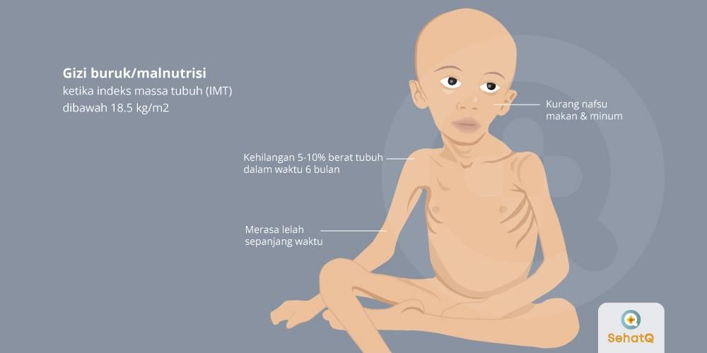 Detail Gambar Anak Penderita Kurang Energy Protein Nomer 35