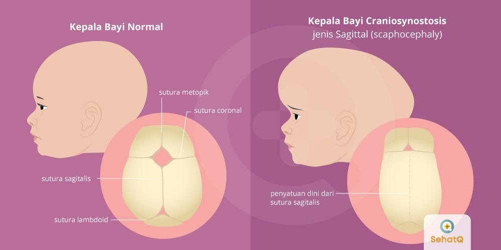 Detail Gambar Anatomi Kepala Bayi Nomer 14