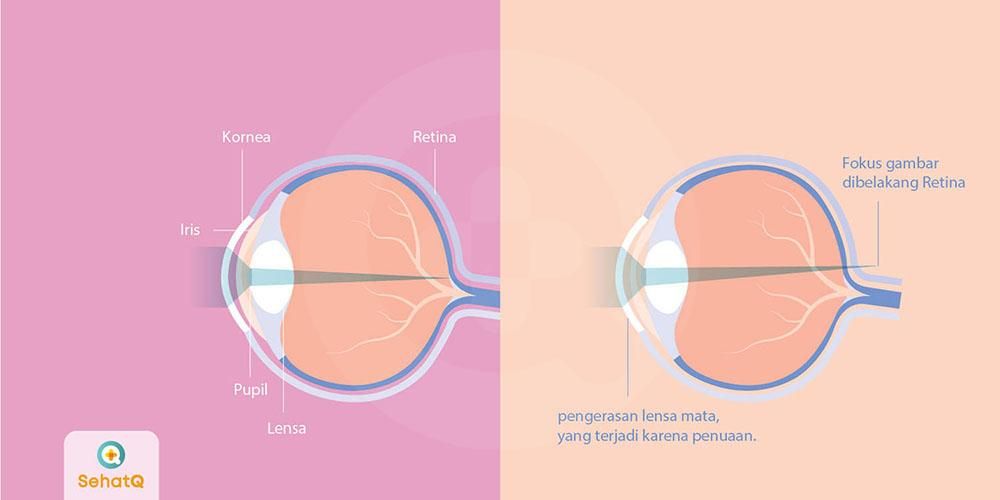 Detail Gambar Anatomi Mata Rabun Nomer 29