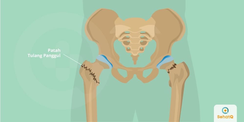 Detail Gambar Anatomi Panggul Nomer 24