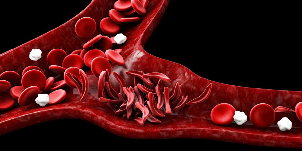 Detail Gambar Anemia Sel Sabit Nomer 11