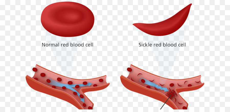 Detail Gambar Anemia Sel Sabit Nomer 19