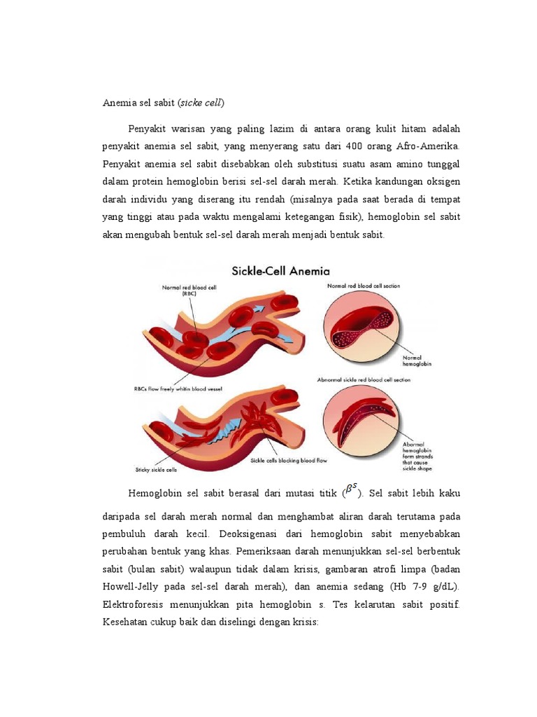 Detail Gambar Anemia Sel Sabit Nomer 36