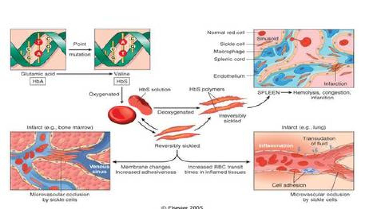 Detail Gambar Anemia Sel Sabit Nomer 40