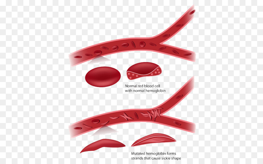 Detail Gambar Anemia Sel Sabit Nomer 45