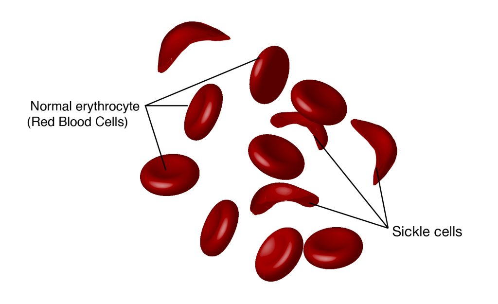 Detail Gambar Anemia Sel Sabit Nomer 10