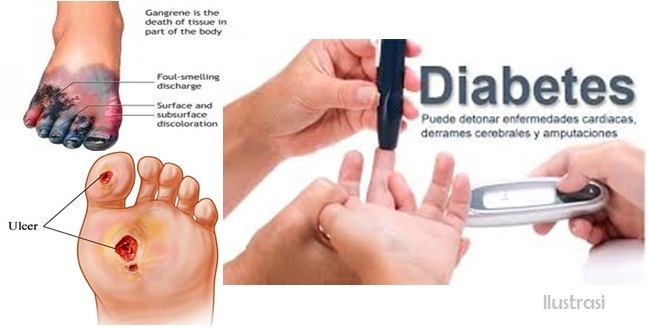 Detail Gambar Animasi Diabetes Melitus Nomer 31