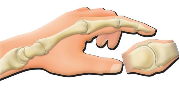 Detail Bruch Mittelhandknochen Nomer 17