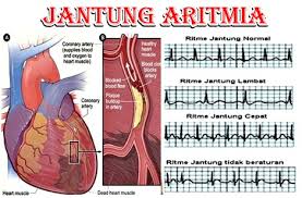 Gambar Aritmia Jantung - KibrisPDR