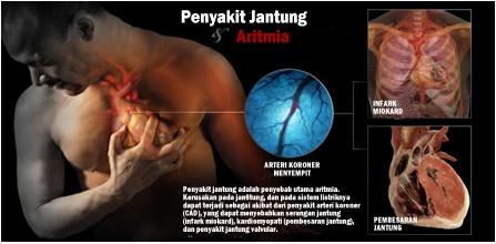 Detail Gambar Aritmia Jantung Nomer 16