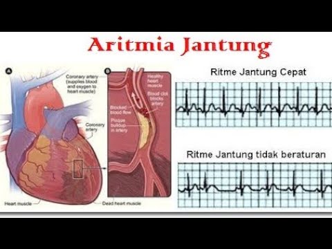 Detail Gambar Aritmia Jantung Nomer 20