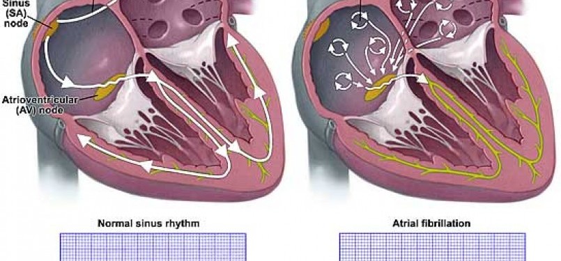 Detail Gambar Aritmia Jantung Nomer 4