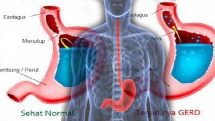 Detail Gambar Asam Lambung Naik Nomer 49