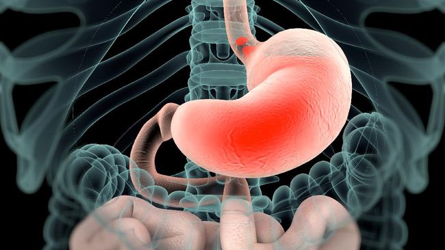 Detail Gambar Asam Lambung Naik Nomer 7