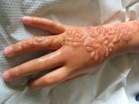 Gambar Bahaya Pakai Henna - KibrisPDR