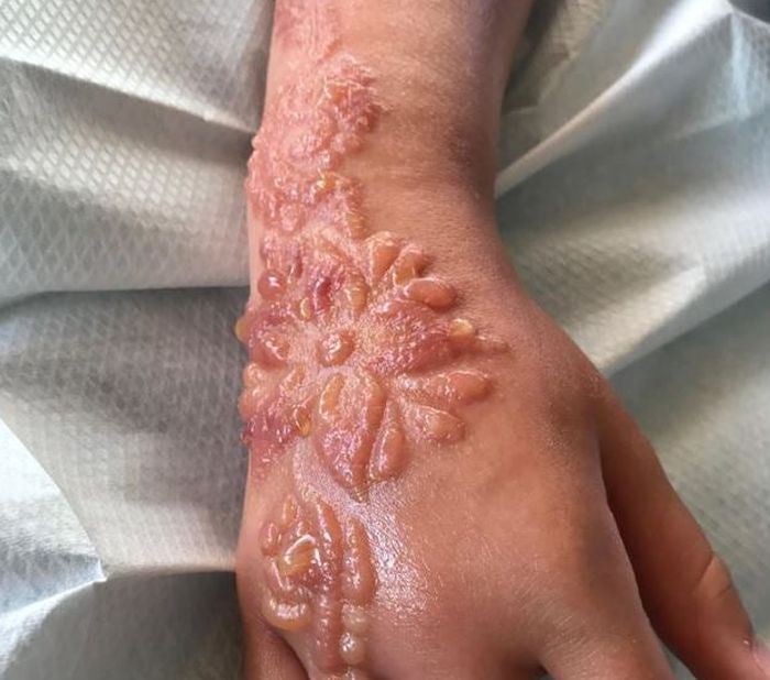 Detail Gambar Bahaya Pakai Henna Nomer 31