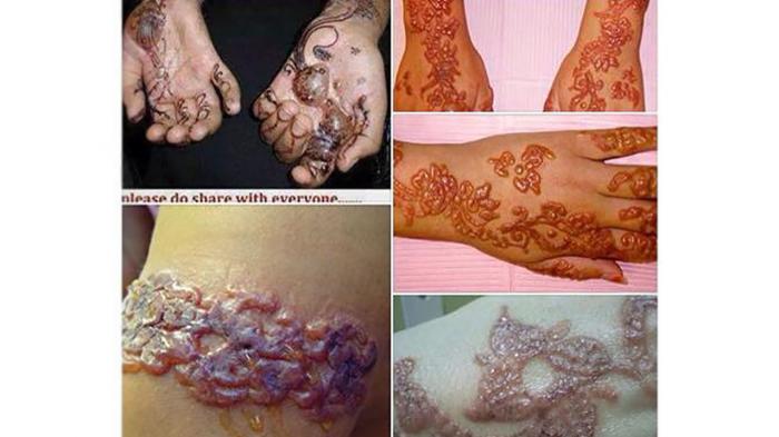 Detail Gambar Bahaya Pakai Henna Nomer 10