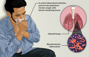 Detail Gambar Bakteri Mycobacterium Tuberculosis Nomer 42